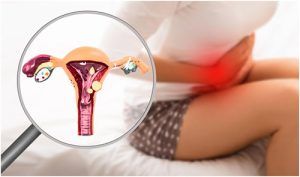 ¿Te han diagnosticado endometriosis?